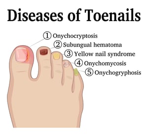 Diseases of the Toenails