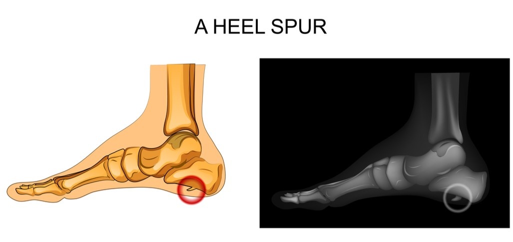 Heel pain heel spur