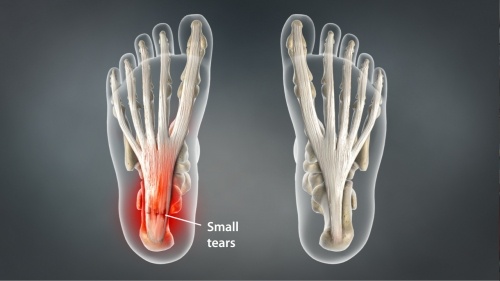 Plantar fasciitis most frequent area of pain