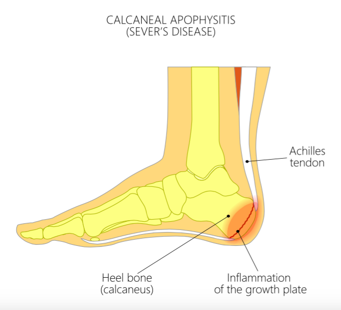 Image Showing Inflammation of heel growth plate