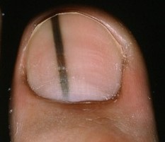 Don't Be Misdiagnosed. Know the Signs of Toenail Melanoma