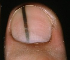 Don't Be Misdiagnosed. Know the Signs of Toenail Melanoma Don't Be Misdiagnosed. Know the Signs of Toenail Melanoma