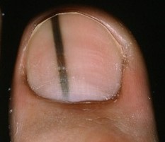 Spot toenail black under Black Toenails: