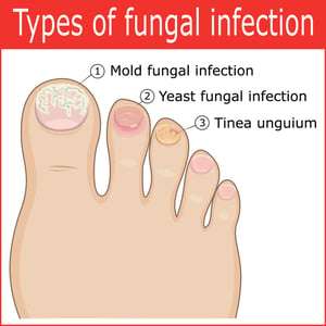Types-of-toenail-fungal-infection