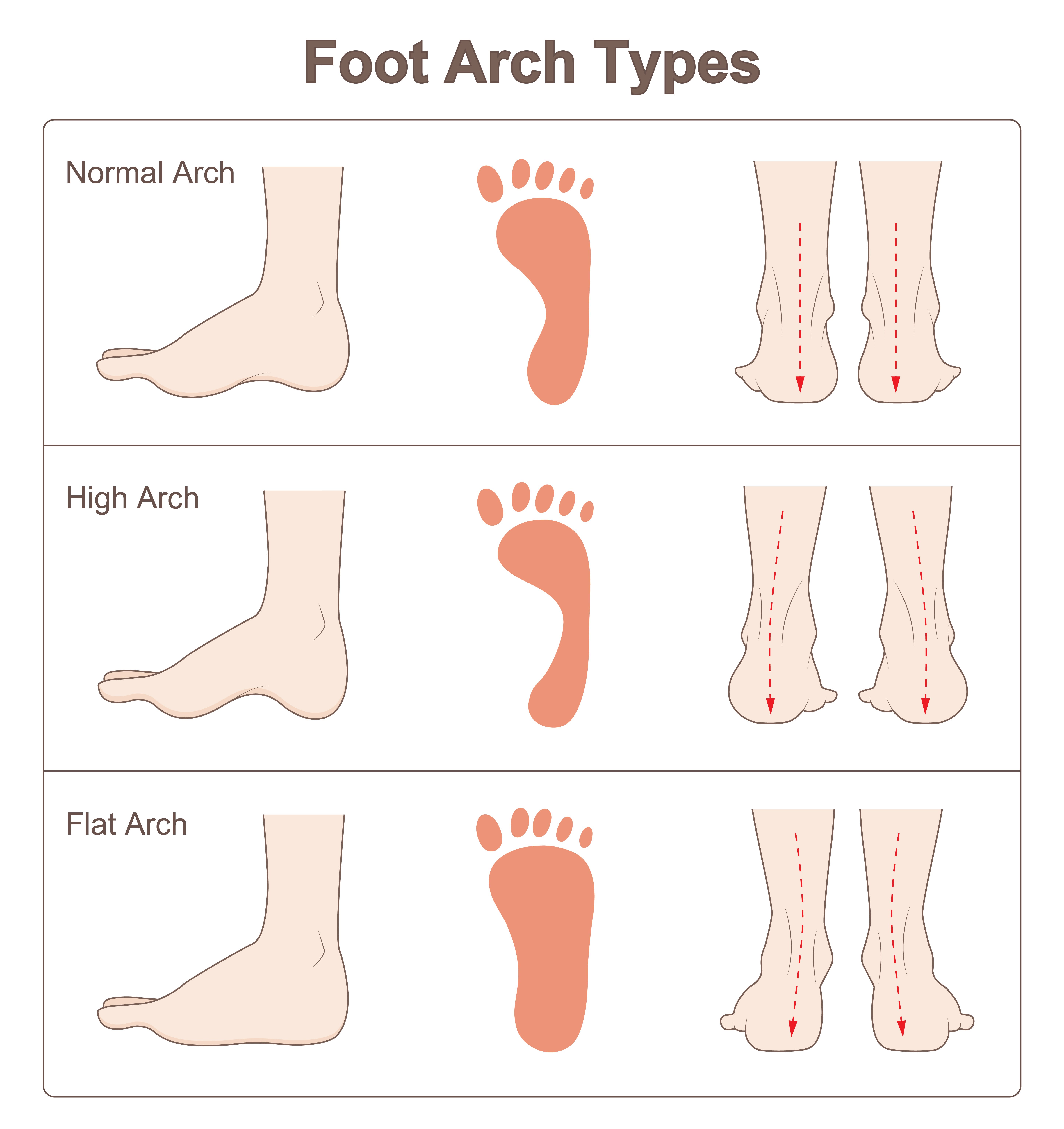 Foot arch. Высокий свод стопы. Плоская стопа [pes planus] (приобретенная). Erikas feet. Foot arch.