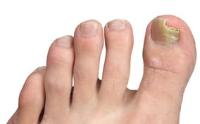 toenail fungus yellow nail