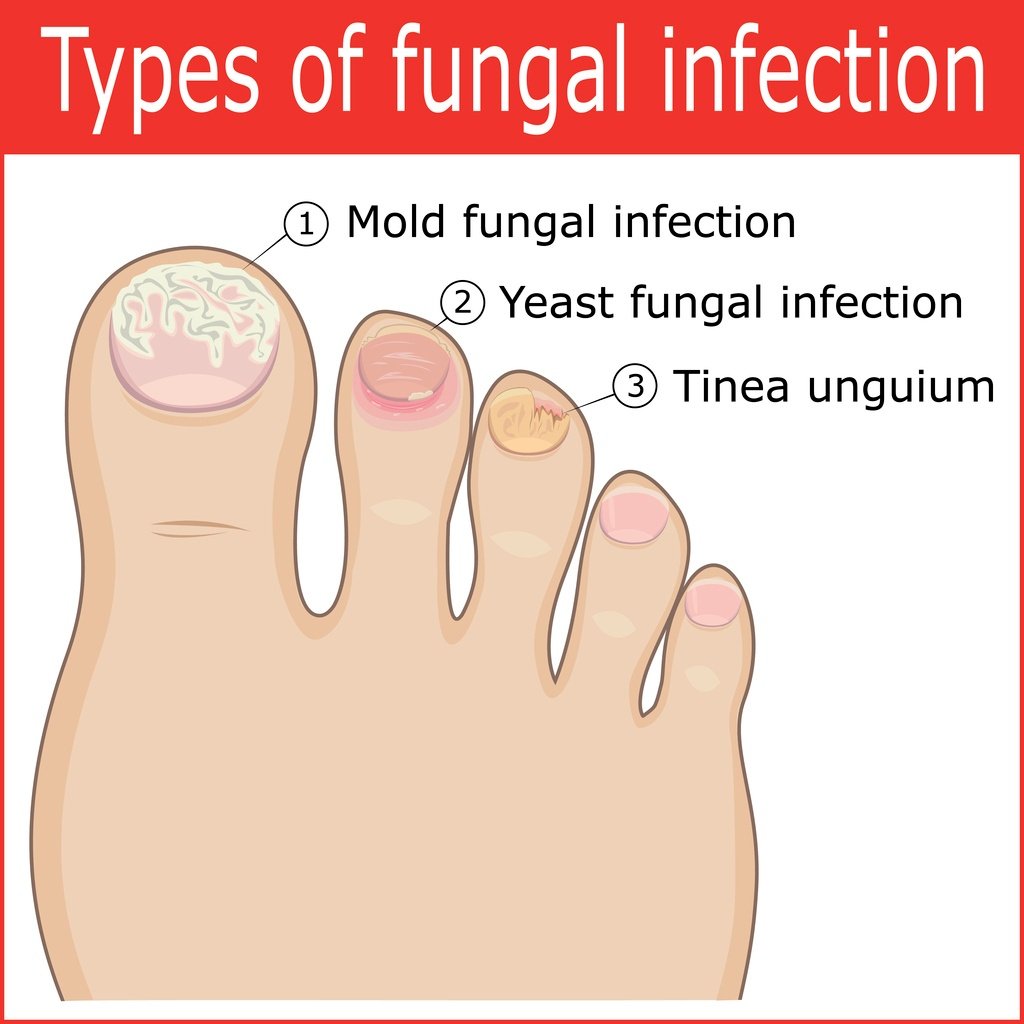 Types-of-toenail-fungal-infection